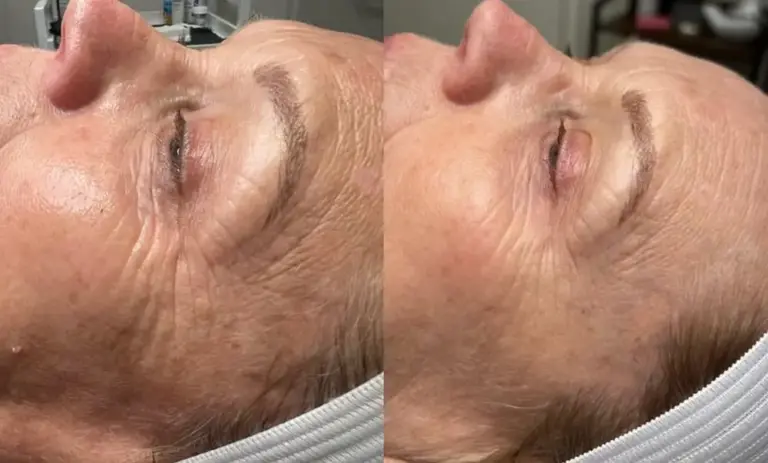 Before and After Microneedling